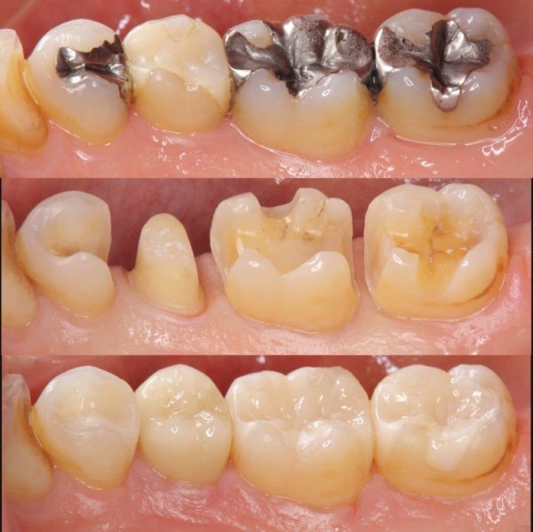 Sind Amalgam-Füllungen noch zeitgemäß? – Zahnarzt Ahrweiler – Dr. Simone  Gangl – Moderne Zahnmedizin für die ganze Familie
